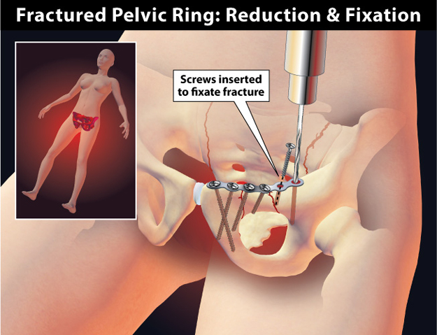 Pelvic Fracture